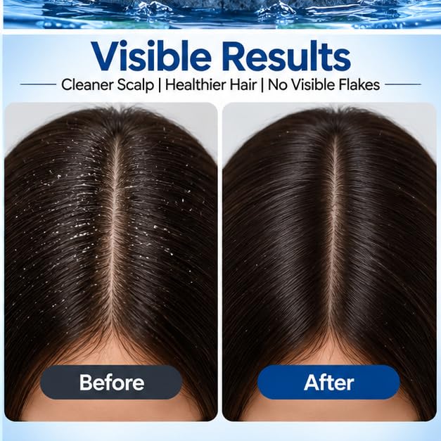 Xiraya Anti Dandruff Conditioner 200 ml with Tea Tree Extract & Natural Actives, Nourishing Scalp Conditioner for Flake Care, Smoother Hair & Fresh Scalp Feel