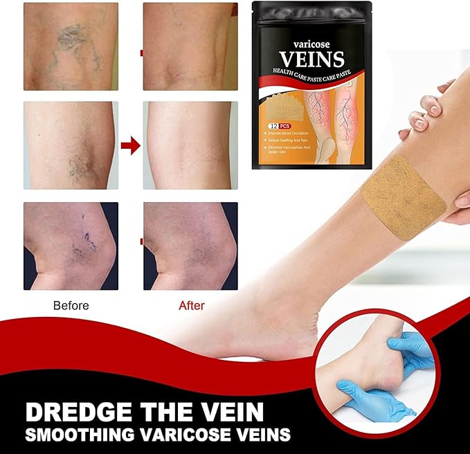 Varicose Vein Care Patches (12 Patches)