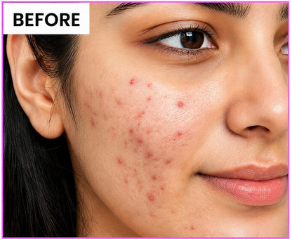 Niacid Face Serum  Anti-Aging Formula | Clear Acne | Even Skin Tone