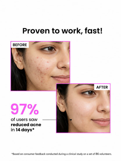 Niacid Face Serum  Anti-Aging Formula | Clear Acne | Even Skin Tone
