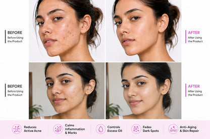 Niacid Face Serum  Anti-Aging Formula | Clear Acne | Even Skin Tone